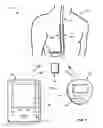 Fig. 02 - Impedance-based stimulation adjustment