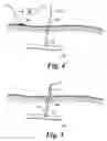 Fig. 03 - Lead insertion tool