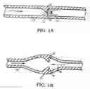 Fig. 02 - Artificial valve