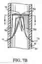 Fig. 12 - Artificial valve