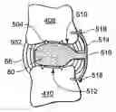 Fig. 01 - Multi-lumen mold for intervertebral prosthesis and method of using same
