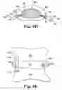Fig. 06 - Multi-lumen mold for intervertebral prosthesis and method of using same