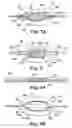 Fig. 08 - Multi-lumen mold for intervertebral prosthesis and method of using same