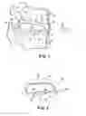 Fig. 02 - Lordosis creating nucleus replacement method and apparatus