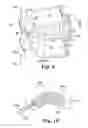 Fig. 06 - Lordosis creating nucleus replacement method and apparatus