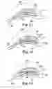 Fig. 07 - Lordosis creating nucleus replacement method and apparatus