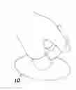 Fig. 01 - Hernial prosthesis for intraprosthetic fixation