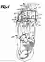 Fig. 03 - Anterior transverse arch support with phalanges grip