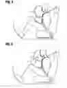Fig. 05 - Passenger protective device and method