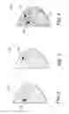 Fig. 03 - Controlling thick-slice viewing of breast ultrasound data