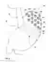 Fig. 09 - Devices for augmentation of lumen walls