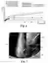 Fig. 05 - Sustained release implants and methods for subretinal delivery of bioactive agents to treat or prevent retinal disease