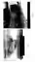 Fig. 04 - Composition and method for the therapeutic modulation of matrix metalloproteinase