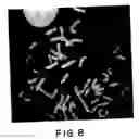 Fig. 09 - Detection of chromosomal abnormalities associated with breast cancer
