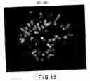 Fig. 14 - Detection of chromosomal abnormalities associated with breast cancer