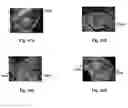 Fig. 44 - Methods and pharmaceutical compositions for healing wounds