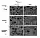 Fig. 02 - Method of treating myelodysplastic syndromes