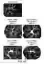 Fig. 14 - Compositions and methods for the treatment of inflammatory bowel disease utilizing NF-kappaB decoy polynucleotides