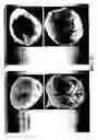 Fig. 18 - Method of treatment of myocardial infarction