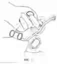 Fig. 07 - IVS obturator instrument and procedure