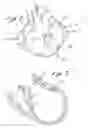 Fig. 03 - Anterior segment ventricular restoration apparatus and method
