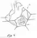 Fig. 04 - Anterior segment ventricular restoration apparatus and method