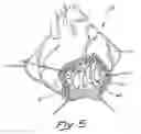 Fig. 05 - Anterior segment ventricular restoration apparatus and method