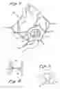 Fig. 08 - Anterior segment ventricular restoration apparatus and method