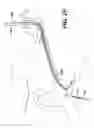 Fig. 24 - Apparatus useful for positioning a device on an endoscope