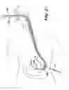 Fig. 26 - Apparatus useful for positioning a device on an endoscope