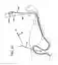 Fig. 31 - Apparatus useful for positioning a device on an endoscope