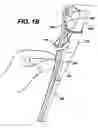 Fig. 04 - Method of inserting a feeding tube