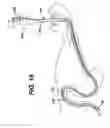 Fig. 17 - Method of inserting a feeding tube