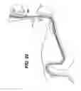 Fig. 19 - Method of inserting a feeding tube