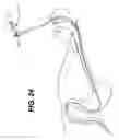 Fig. 23 - Method of inserting a feeding tube