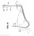 Fig. 30 - Method of inserting a feeding tube