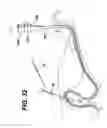 Fig. 31 - Method of inserting a feeding tube
