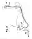 Fig. 32 - Method of inserting a feeding tube
