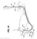 Fig. 33 - Method of inserting a feeding tube