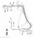 Fig. 34 - Method of inserting a feeding tube