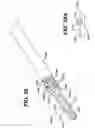 Fig. 37 - Method of inserting a feeding tube