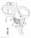Fig. 45 - Method of inserting a feeding tube