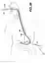 Fig. 25 - Track for medical devices