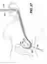 Fig. 26 - Track for medical devices