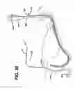 Fig. 34 - Track for medical devices