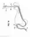 Fig. 17 - Sheath for use with an endoscope
