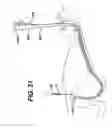 Fig. 30 - Sheath for use with an endoscope