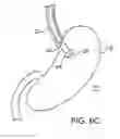 Fig. 08 - Methods and apparatus for maintaining sterility during transluminal procedures