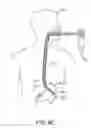 Fig. 13 - Methods and apparatus for maintaining sterility during transluminal procedures