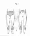 Fig. 05 - Walking assistance device